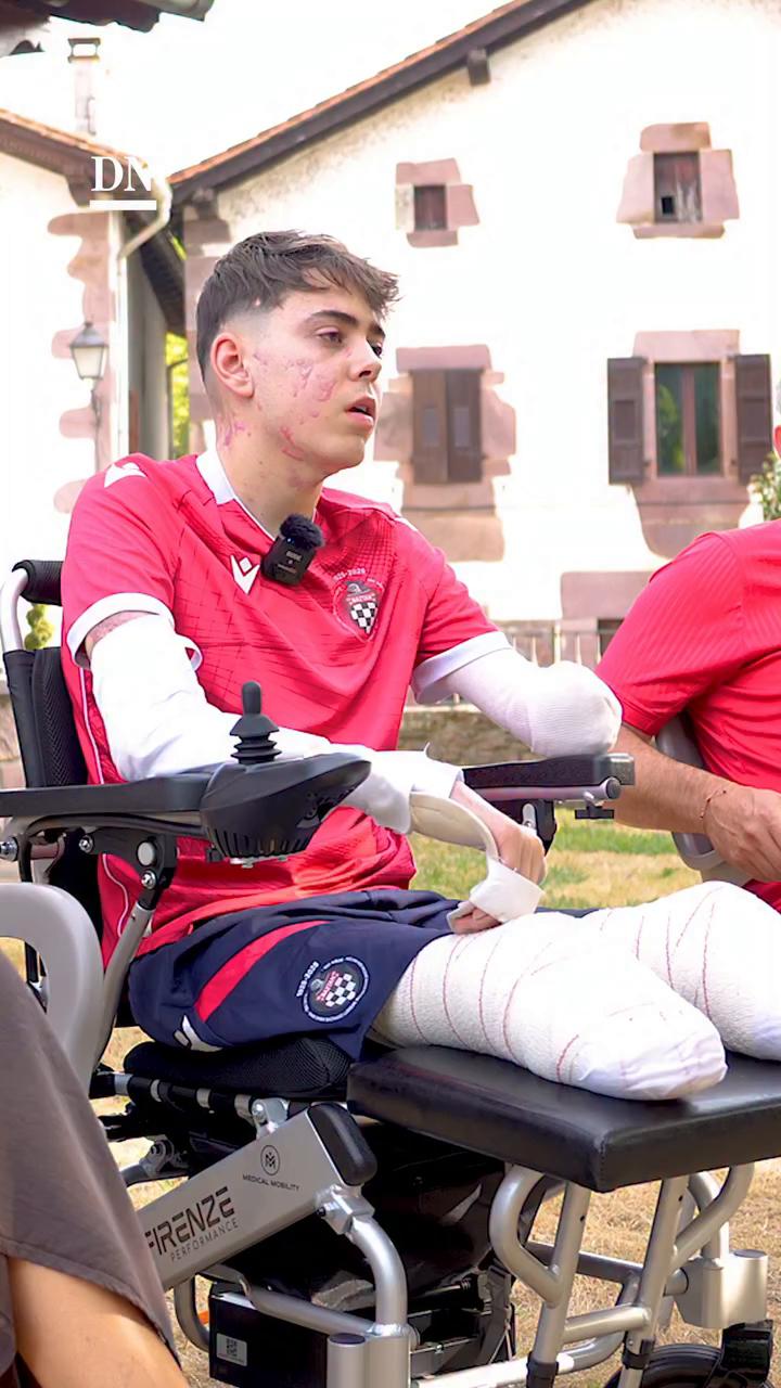 Amputado en Madrid descubre que se puede vivir bien con prótesis