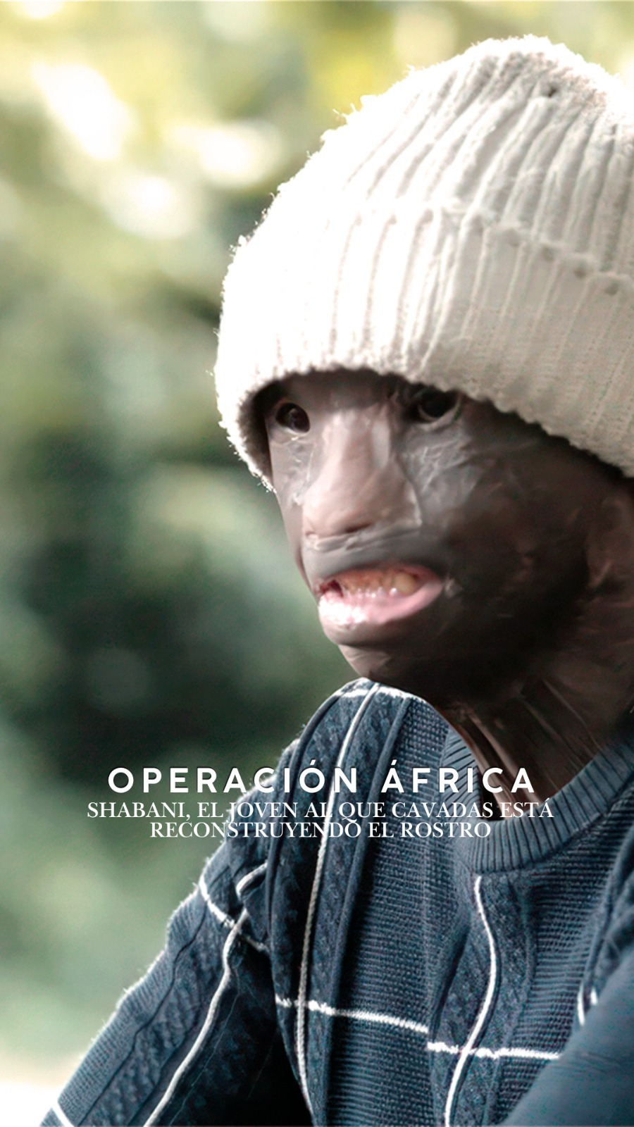 Cirujano reconstruye la nariz de un paciente con quemadura facial tras su paso por India