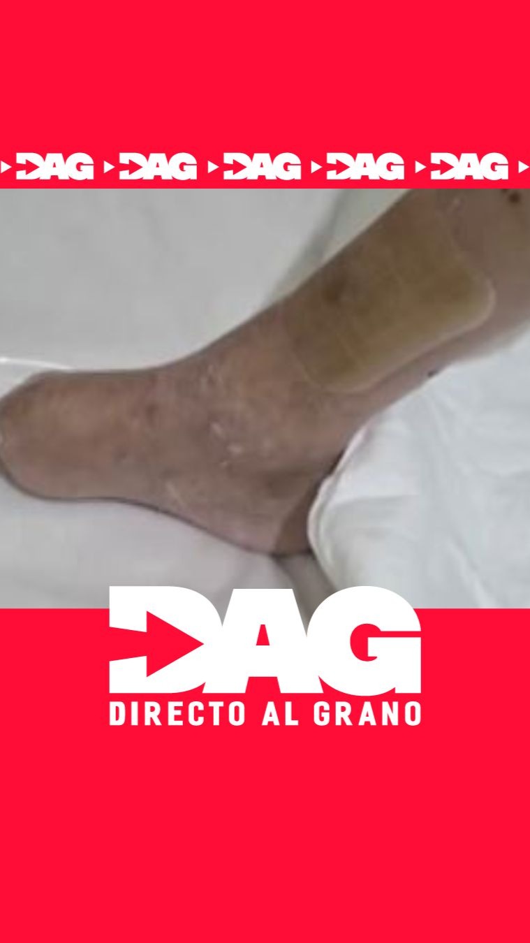Miguel denuncia la recomendación de caminar una hora diaria tras su amputación
