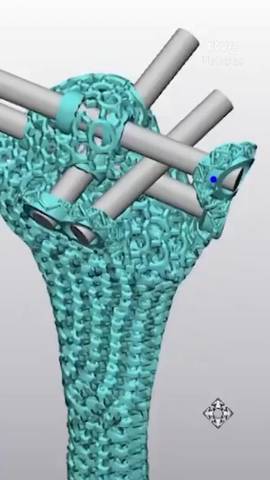 El Hospital General Universitario Gregorio Mara��n de Madrid ha dise�ado y fabricado la primera pr�tesis �sea a medida de metamaterial del mundo.