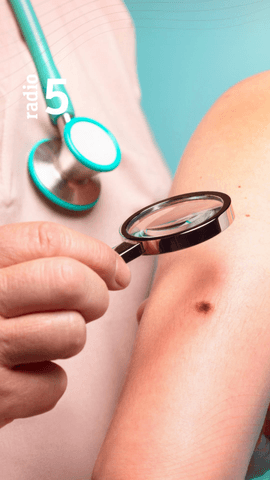 Con la llegada del verano, aumenta la exposición solar y con ello, la posibilidad de desarrollar melanomas, pero, ¿sabes a cuántas personas afecta?