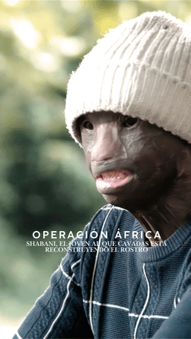 Shabani tiene 30 años, un joven tanzano que sufrió graves quemaduras en el rostro.